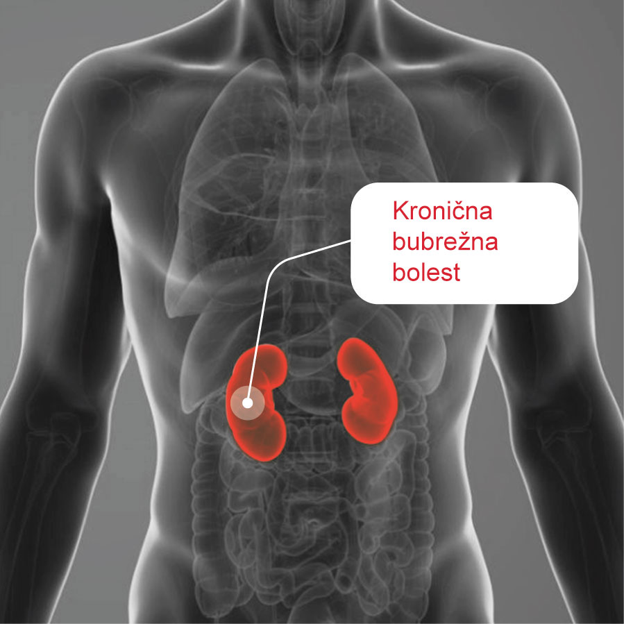 Anatomical representation of the kidneys’ location in relation to chronic kidney disease.