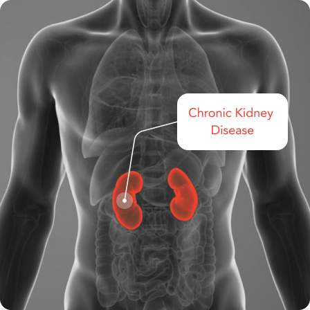 Anatomical representation of the kidneys’ location in relation to chronic kidney disease.